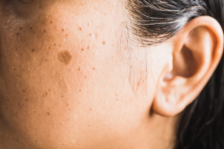 Brown spot treatment